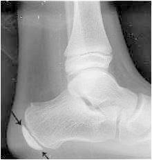 Don't Ignore Your Kids Heel Pain