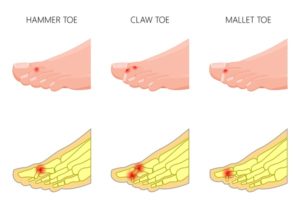 Symptoms of Hammertoes