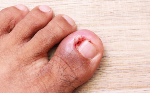 Ingrown Toenails: Treatments and Five Things You Can Do