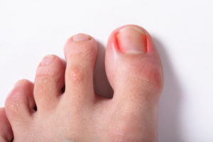 ingrown toenail