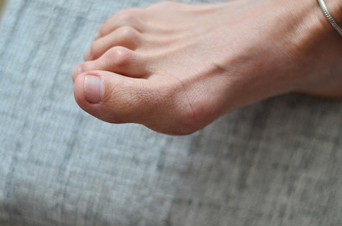 What are the best treatments to straighten painful hammertoes?