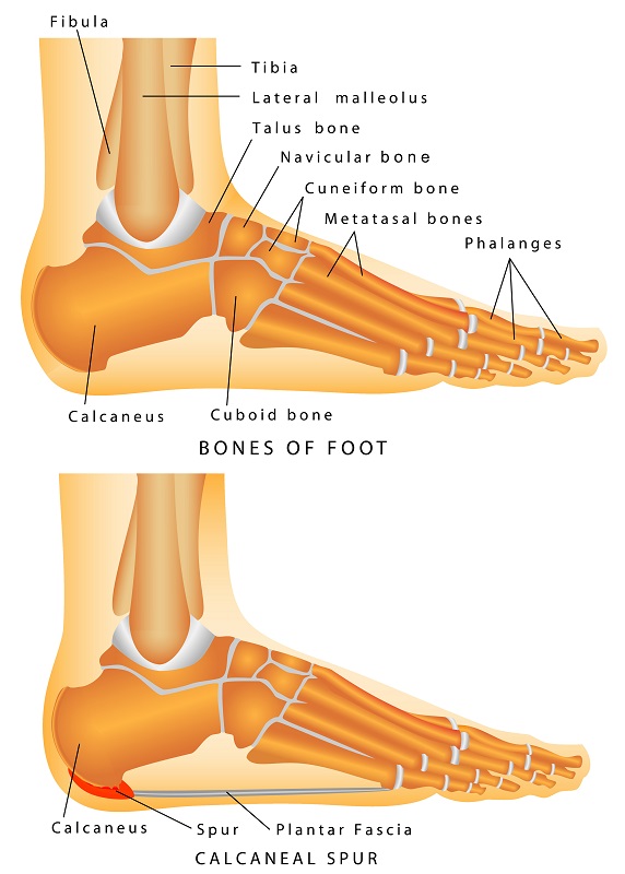 calcaneal spur treatment