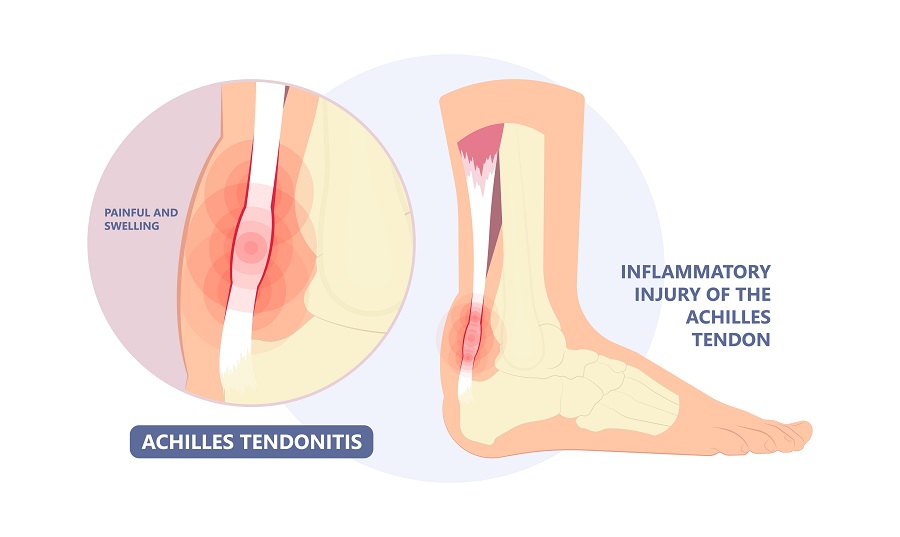Achilles Tendon Heel Pain: How to Avoid it and What are Your Best Treatment Options.