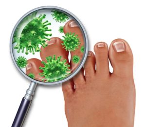 athletes foot treatment