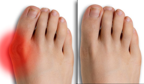 before after bunion surgery