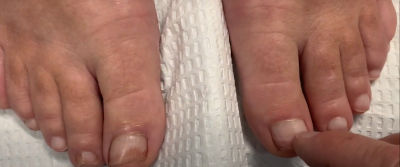 Treatment of Onychomycosis