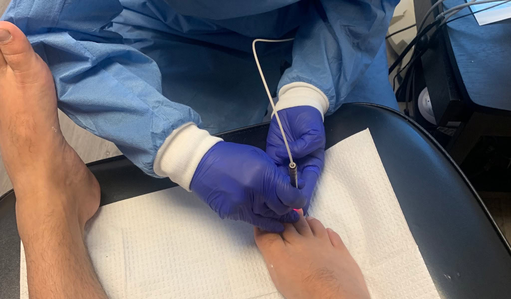 No More Icky Fungal Nails! Consider Laser Toenail Treatment