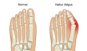 bunion foot normal and hallux valgus