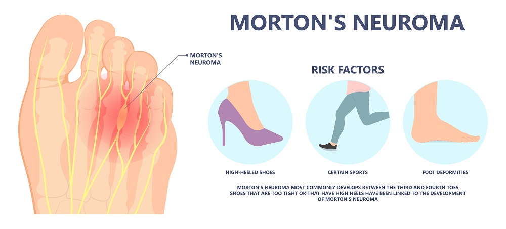 Having Pain in the Ball of Your Feet? Maybe it’s a Morton’s Neuroma