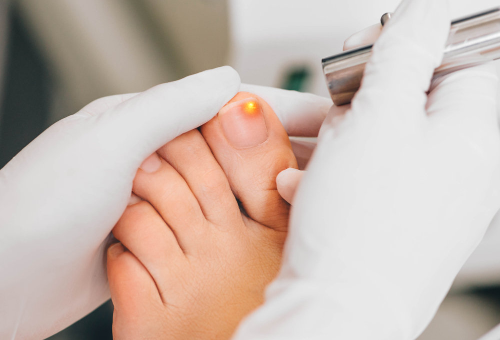 Laser Fungal Toenail Removal! Is It Really Effective As A Long Term Treatment Option?