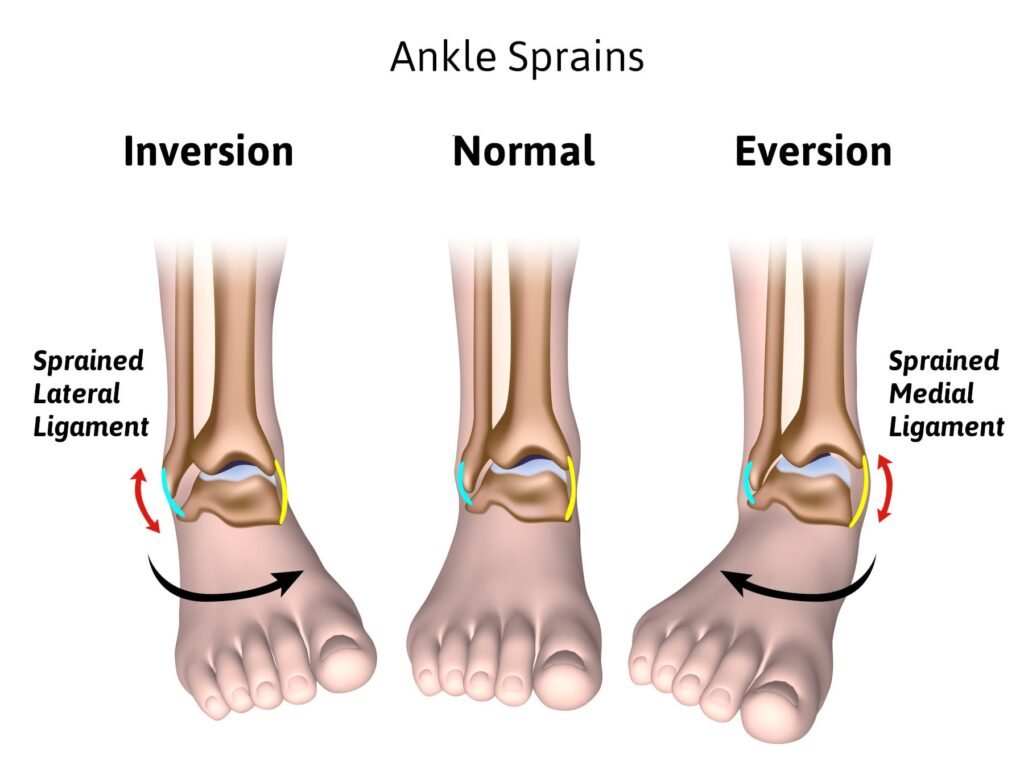 types of ankle sprains anderson podiatry center treatments