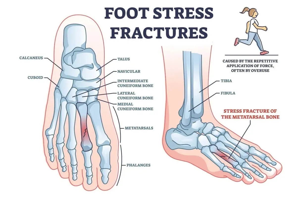 Understanding Stress Fractures in the Foot: Symptoms, Causes, and Prevention