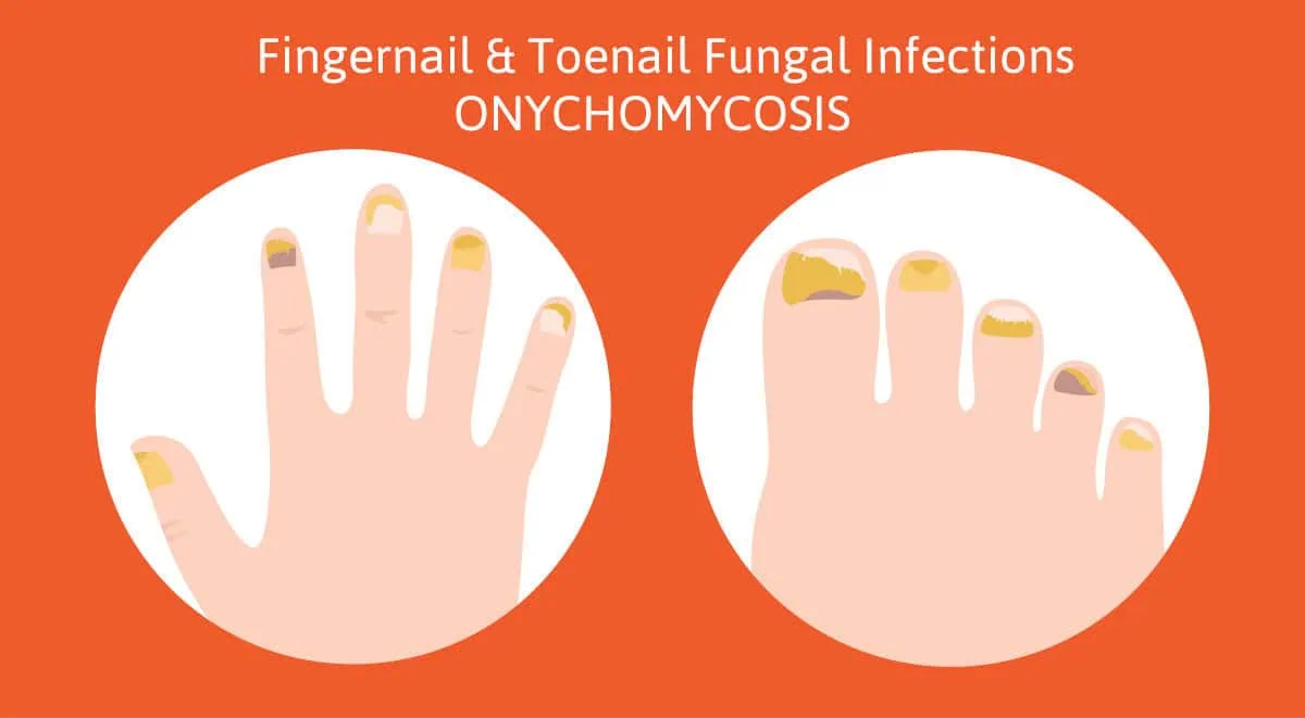 Do I have Fingernail Fungus? What’s The Best Form of Laser Treatment?