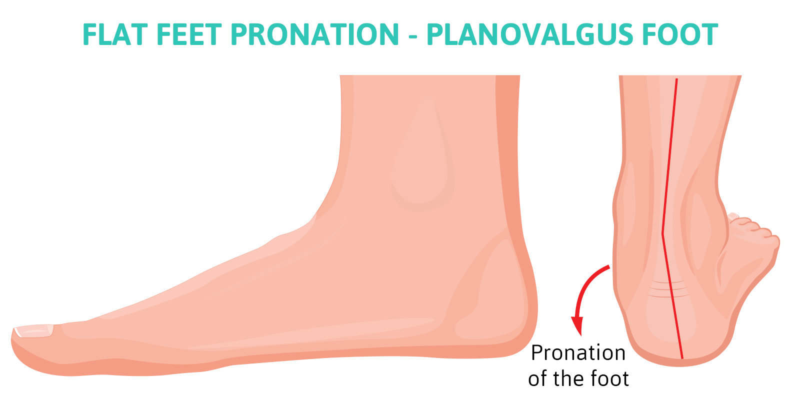 Flat Feet Pronation: To Better Understand Overpronation and Why Flat Feet Are an Issue!