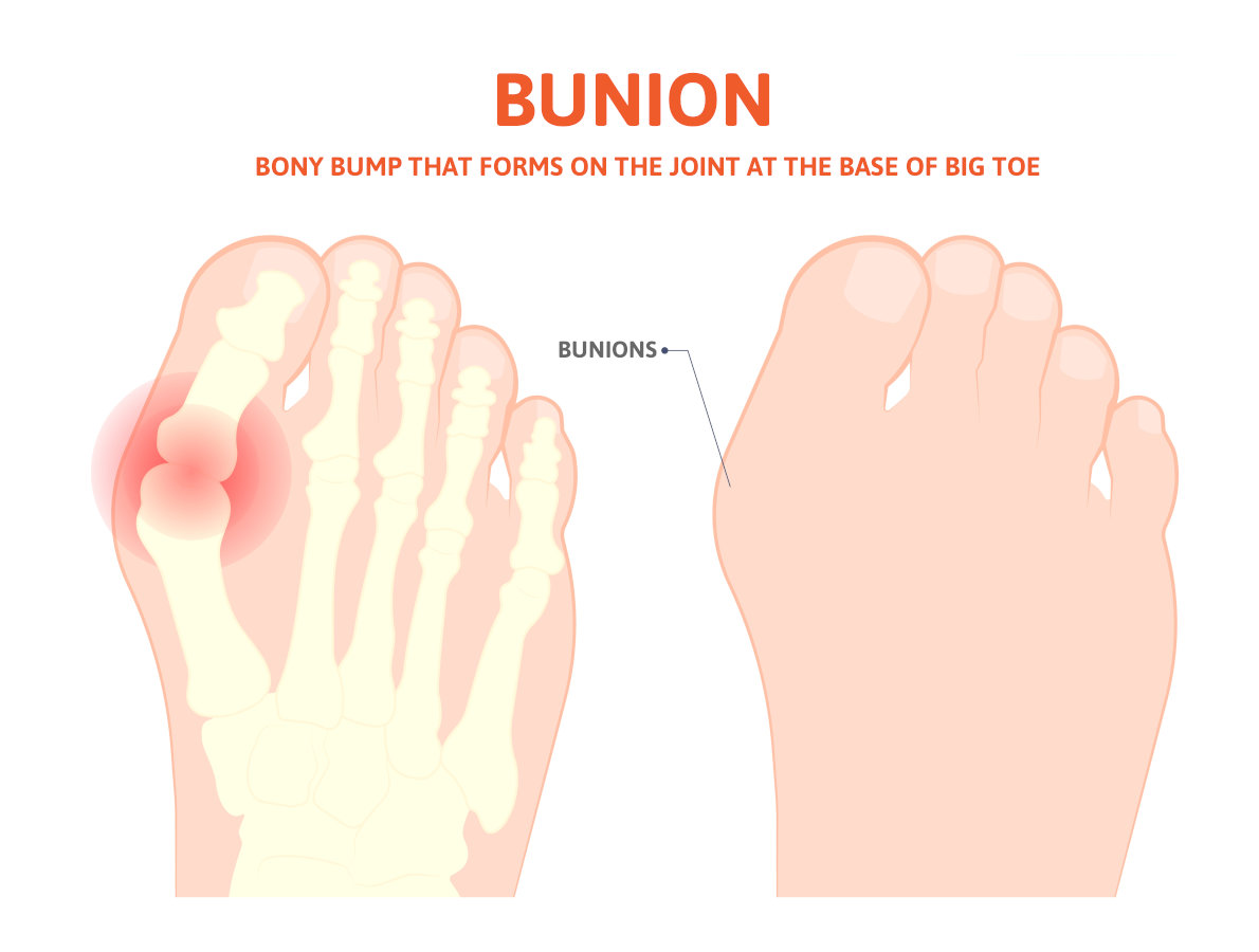 What You Need to Know About Foot Surgery for Bunions and Three Ways They are Corrected!