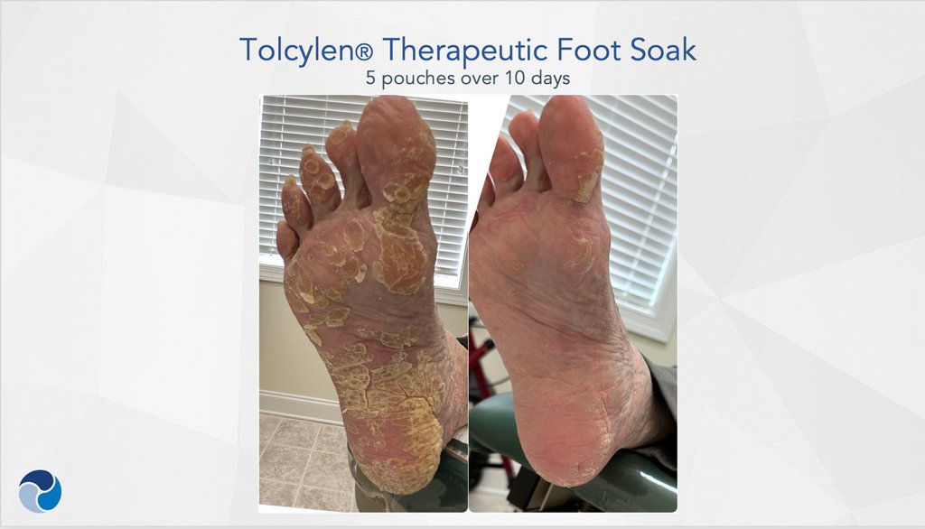 tolcylen-therapeutic-foot-soak-5pouches-10days callus removal