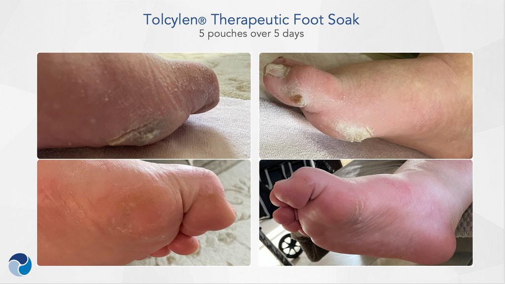 tolcylen-therapeutic-foot-soak-5pouches-10days