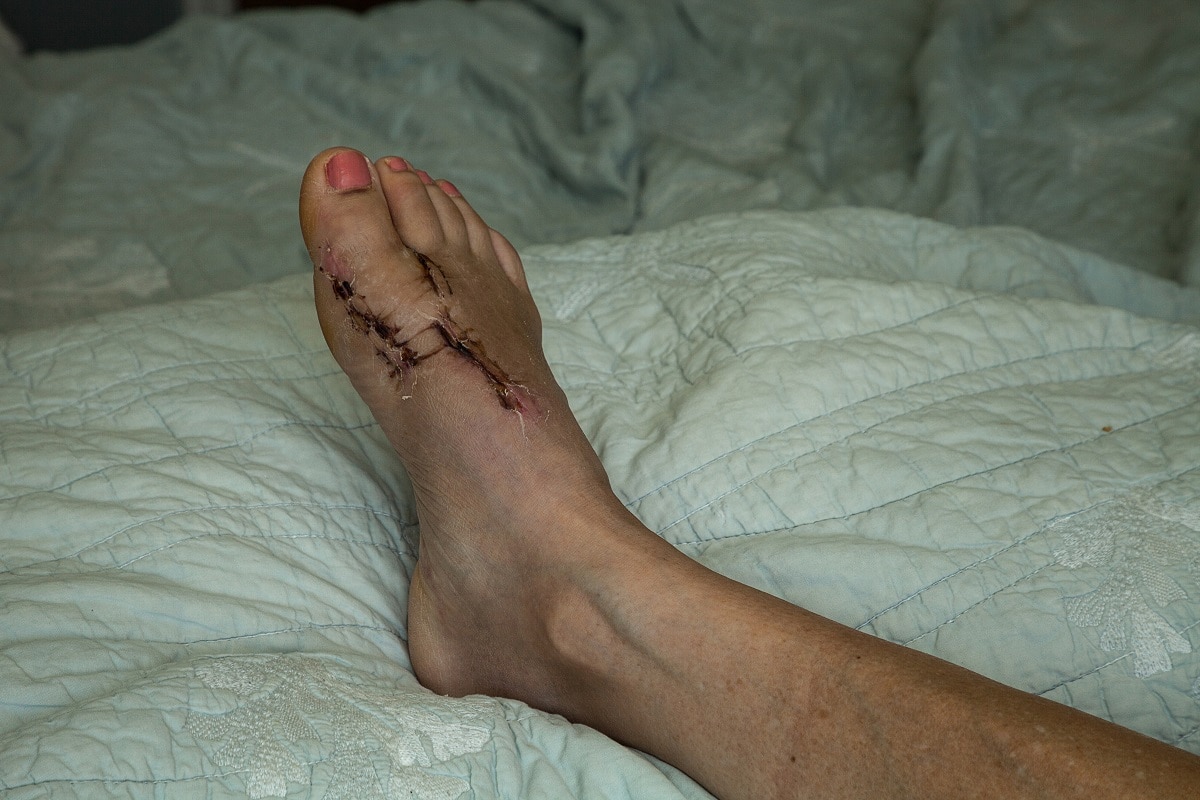 The Perfect Read If You’re Considering Bunion Surgery Lapiplasty!