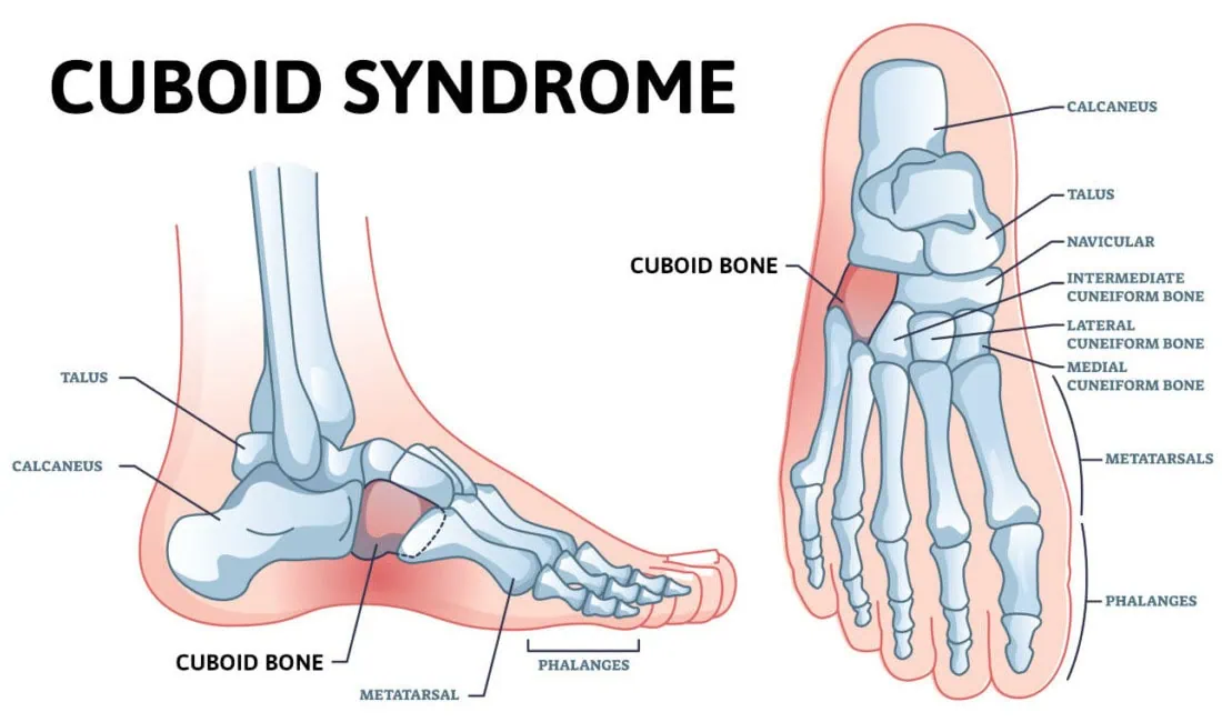 Say Goodbye to Foot Pain: Effective Cuboid Syndrome Treatment
