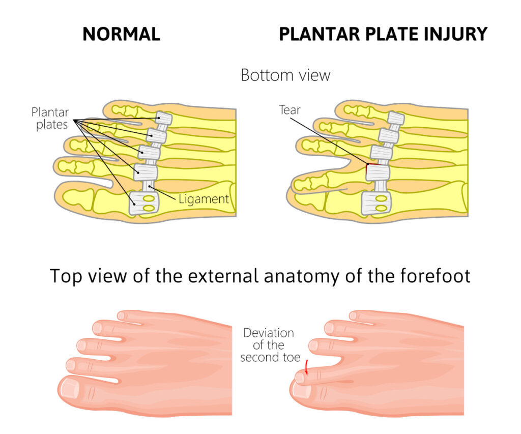 plantar-plate-tear