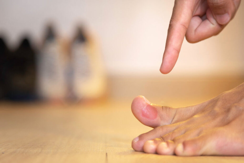 blister infection on toes
