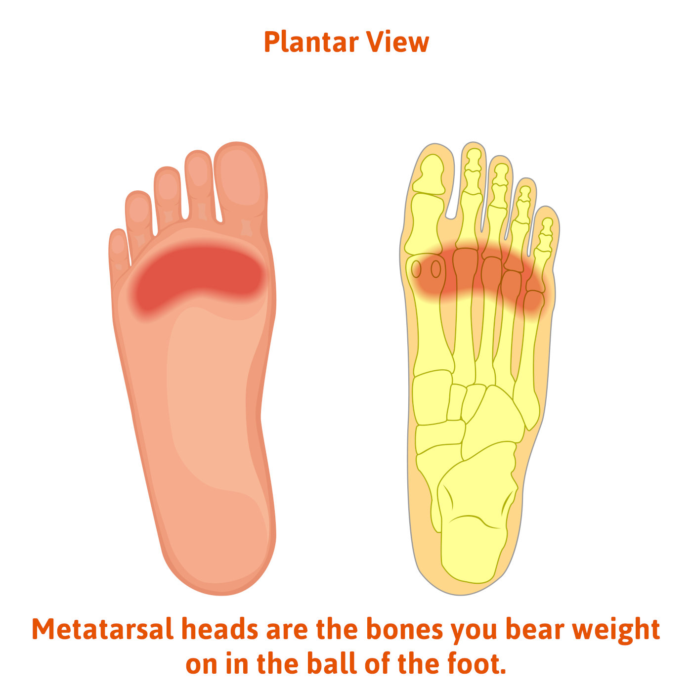 weight bearing bones phalanges freiberg's disease second matatarsal head