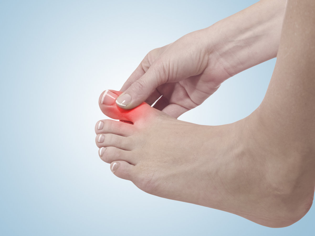Hallux Rigidus Surgery: Is a Big Toe Cheilectomy Right for You?