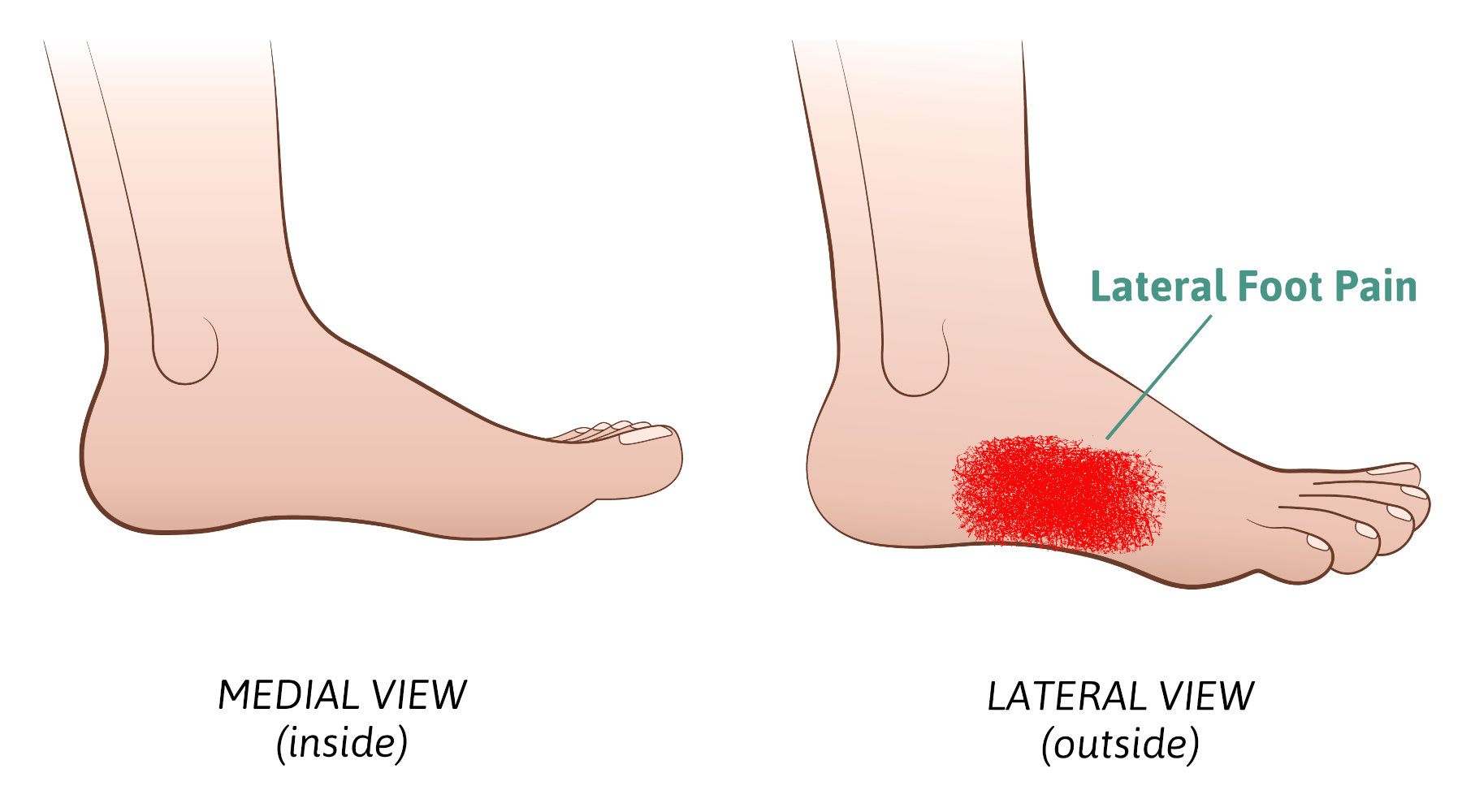 Lateral Foot Pain Slowing You Down. Finding The Source!