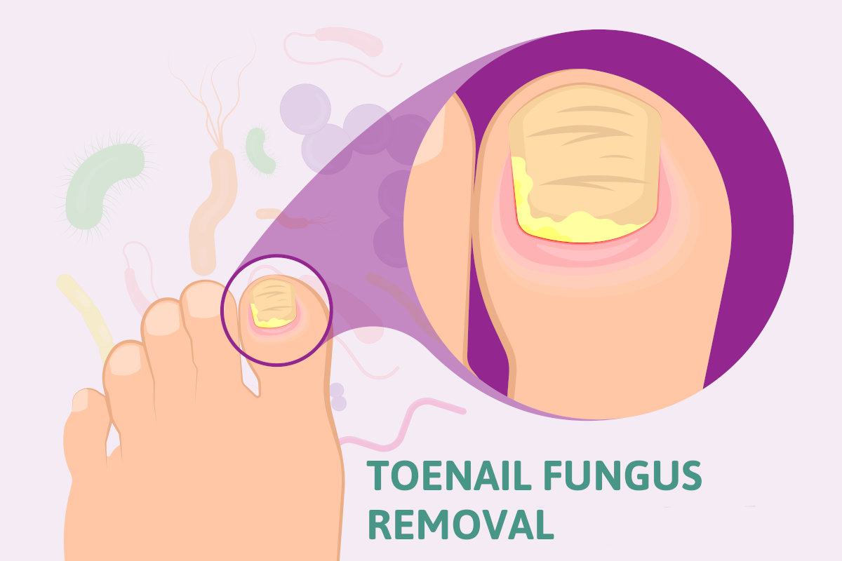 The Four Treatments You Need To Know Regarding Toenail Fungus.