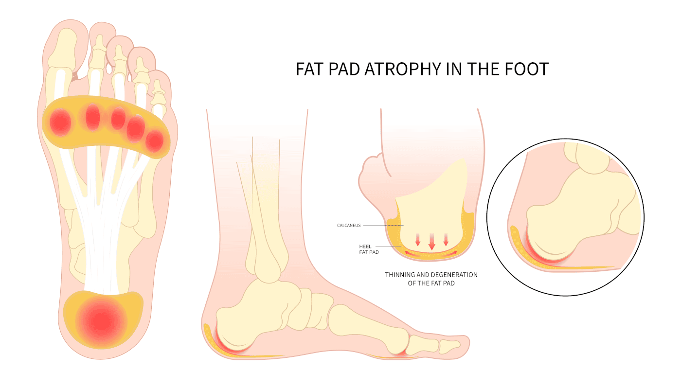 Heel Pad Syndrome: Is it Fallacy or Is it True?
