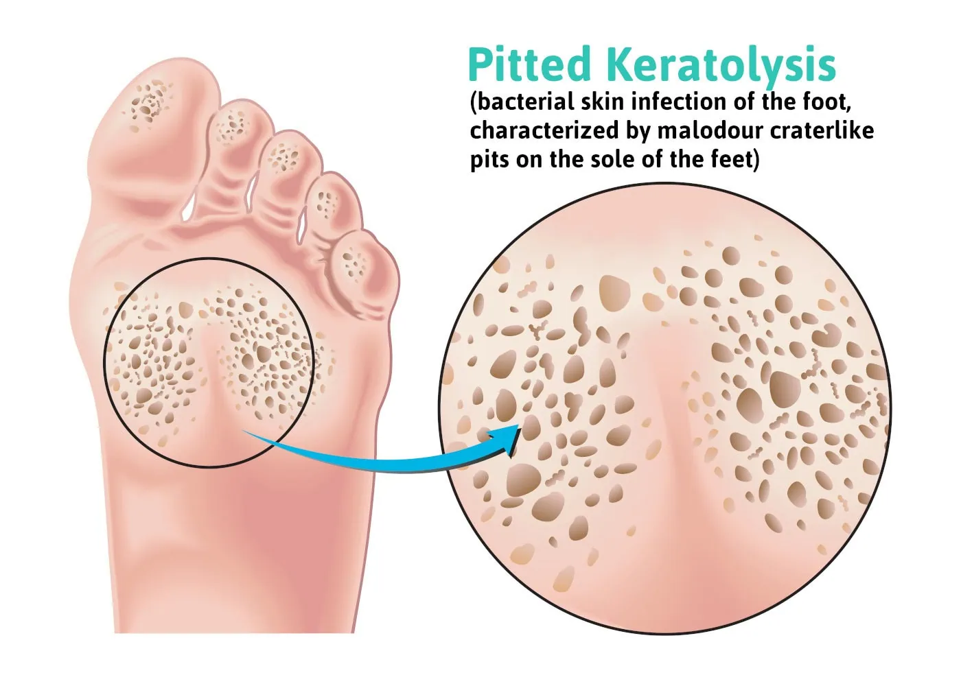 Do You Have Stinky, Itchy Feet? You May Have Pitted Keratolysis
