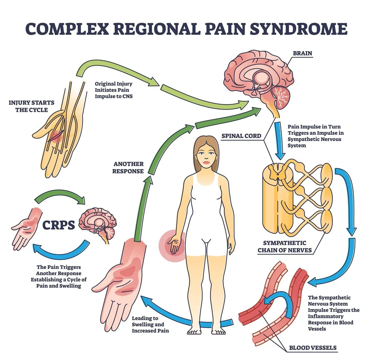 Complex Regional Pain Syndrome: The Story You’re Not Hearing