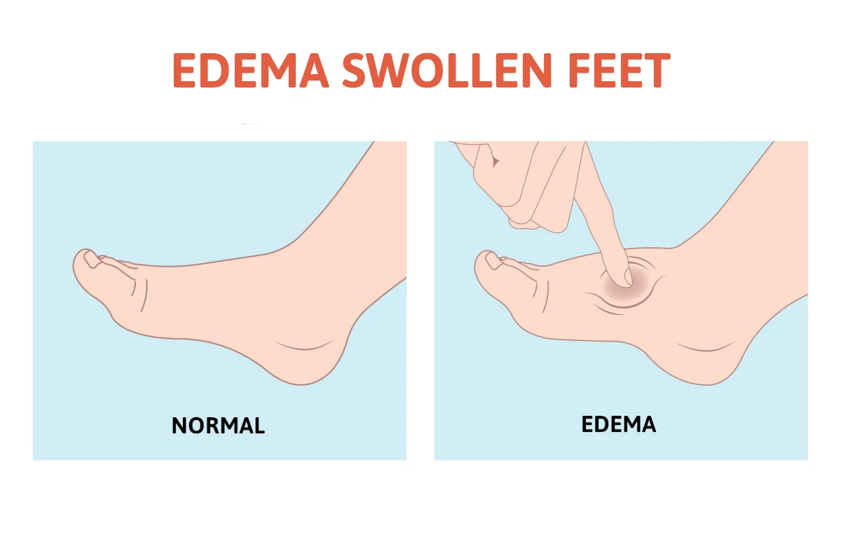 Swollen Legs and Edema: Causes, Symptoms, and Treatment Explained