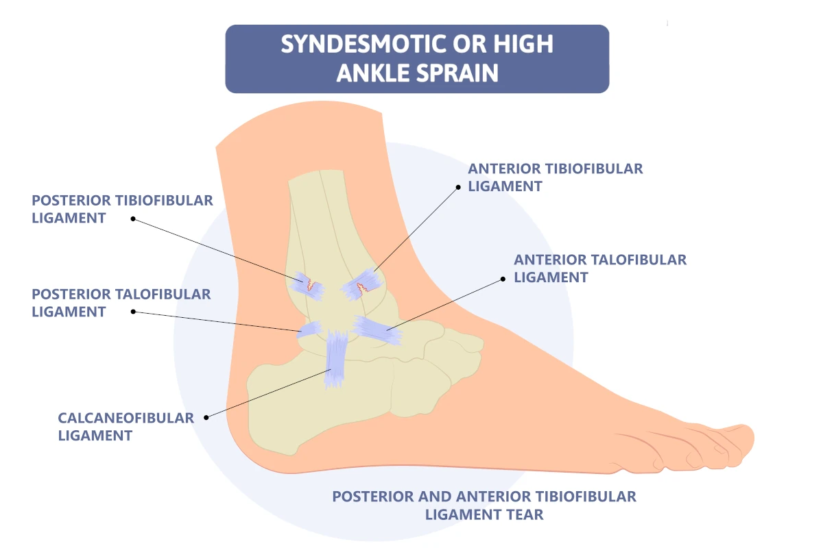 High Syndesmotic Ankle Sprain vs. Regular Ankle Sprain: Key Differences Every Athlete Should Know