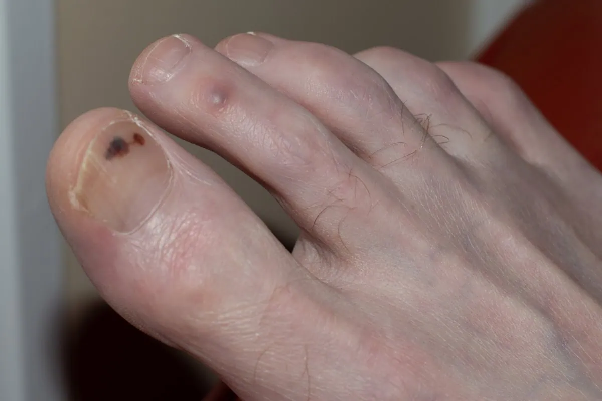 The Black Spot On Toenail: Are You Worried And What To Do