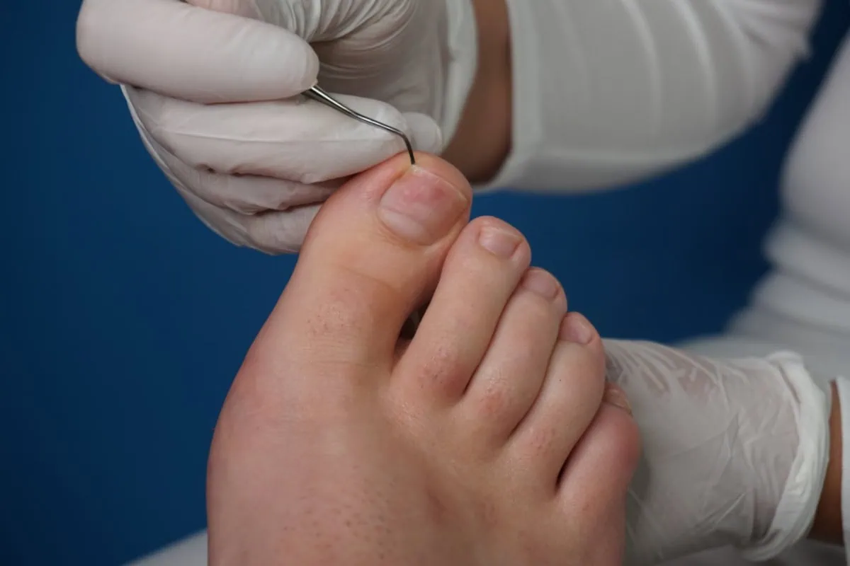 How to Permanently Cure Your Ingrown Toenail: A Podiatrist’s Guide