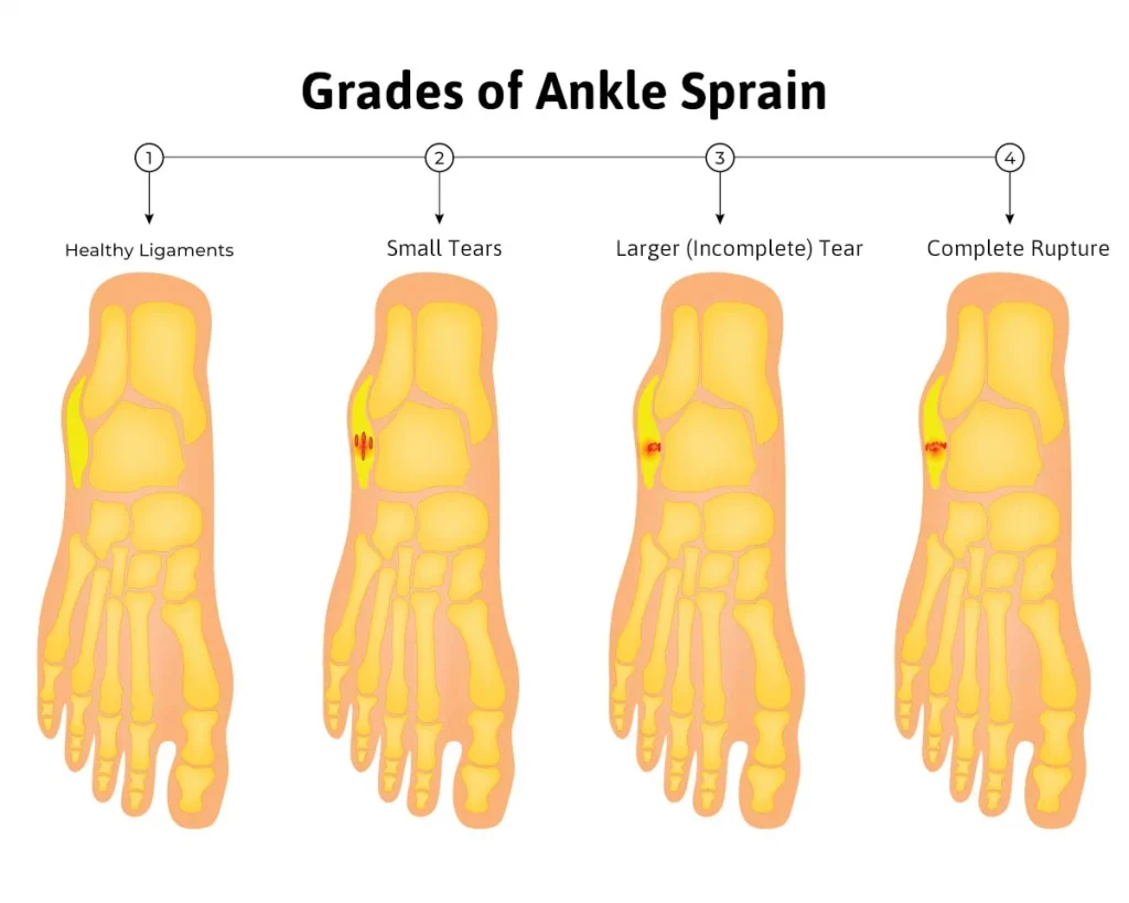 grades ankle sprain anderson podiatry center