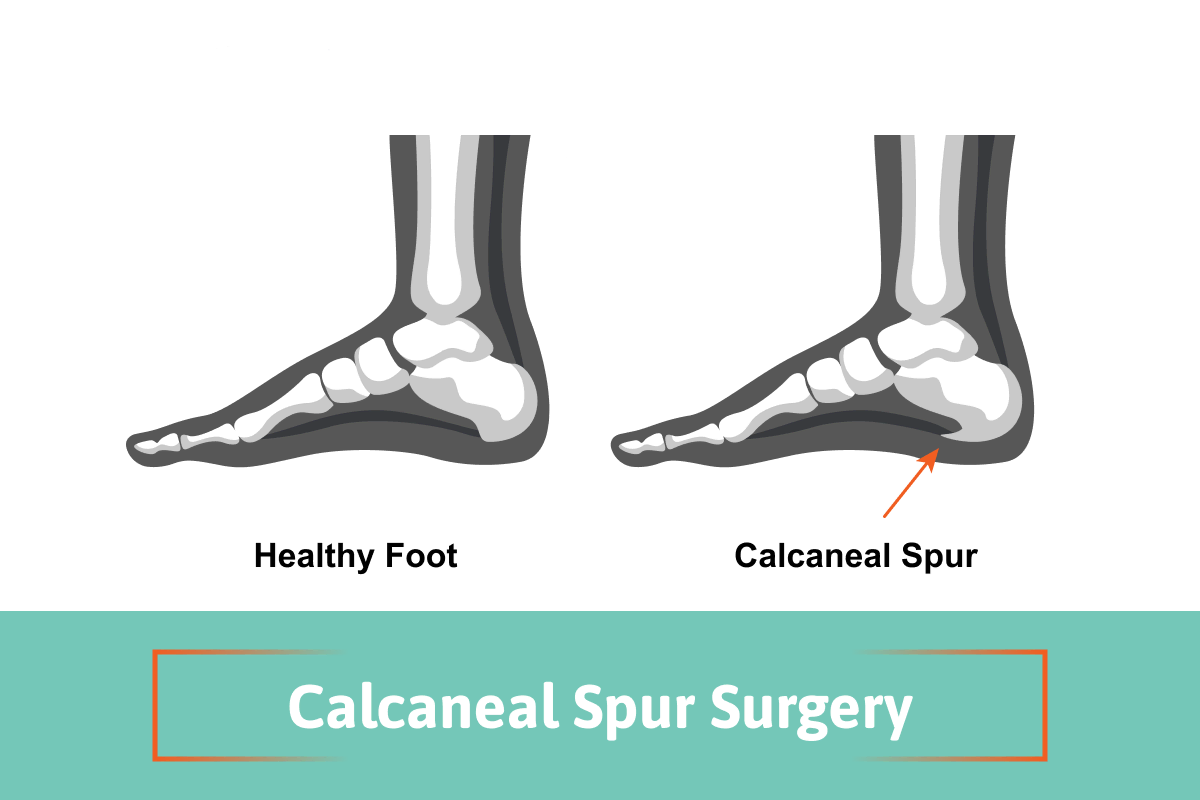 The Hidden Truth About Calcaneal Spur Surgery: What Your Doctor May Not Tell You
