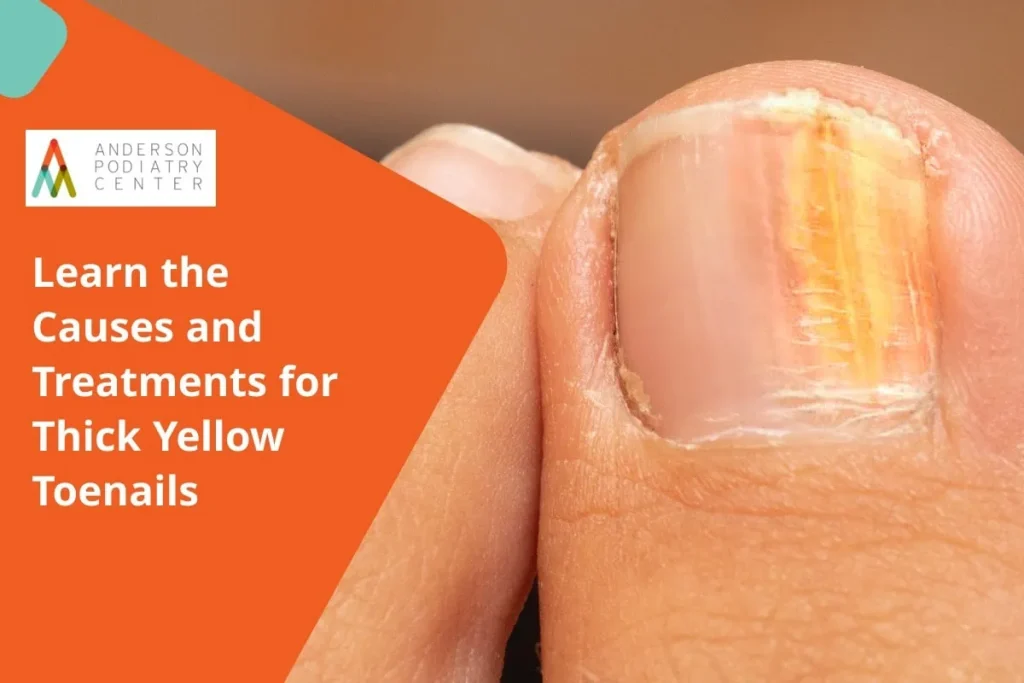 Learn the Causes and Treatments for Thick Yellow Toenails