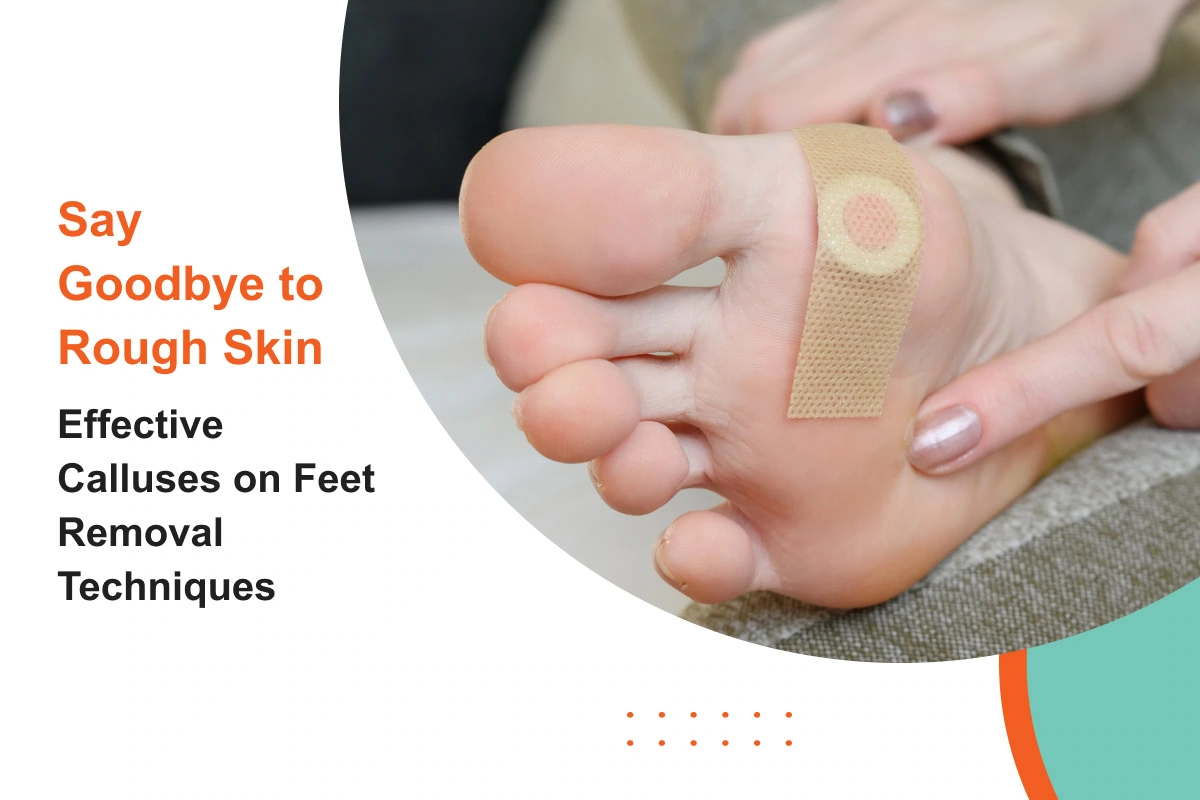 calluses on feet removal