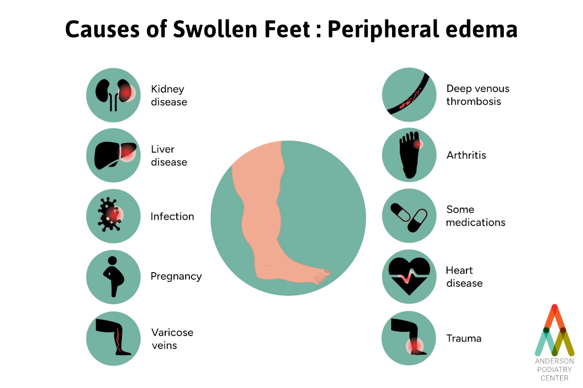 causes of swollen foot peripheral edema